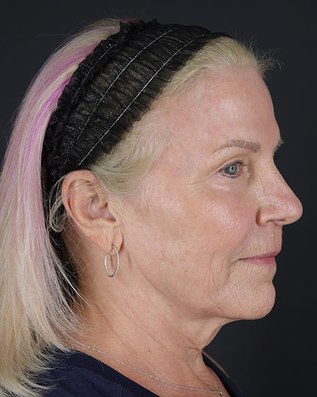 Blepharoplasty and Brow Lift Before & After Image