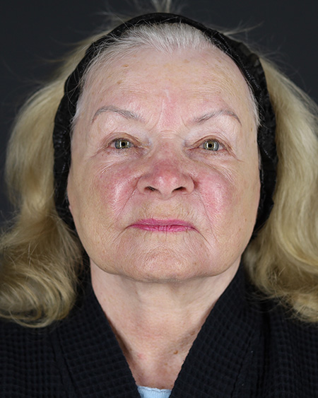 Facelift Before & After Image