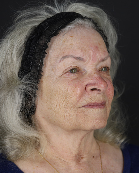 Facelift Before & After Image