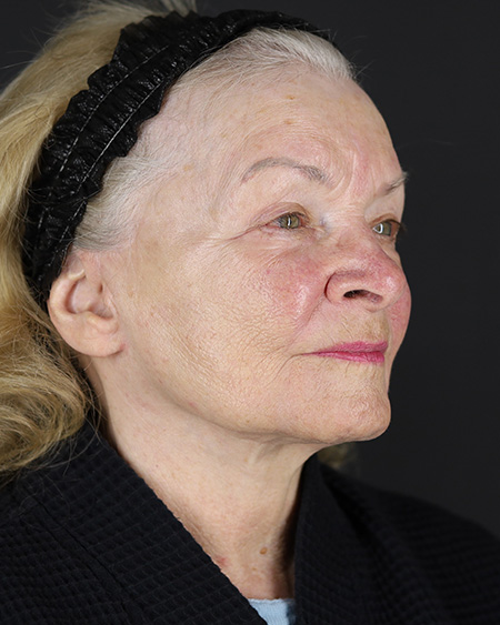 Facelift Before & After Image