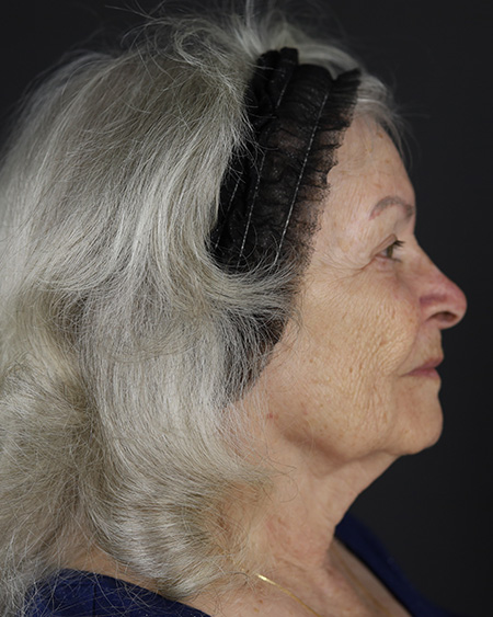 Facelift Before & After Image