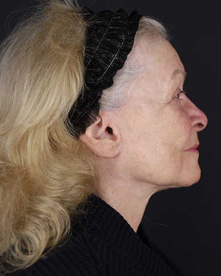 Facelift Before & After Image