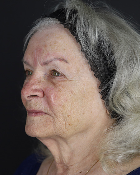 Facelift Before & After Image