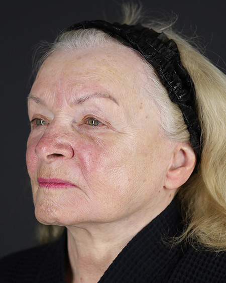 Facelift Before & After Image