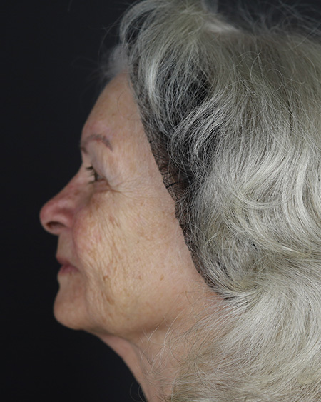 Facelift Before & After Image