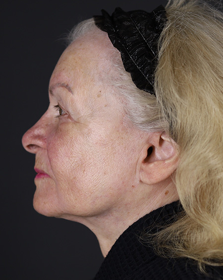 Facelift Before & After Image