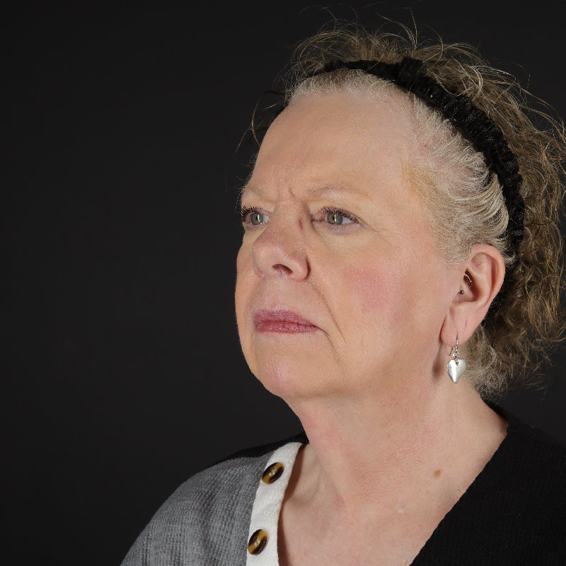 Facelift Before & After Image