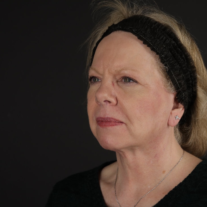 Facelift Before & After Image