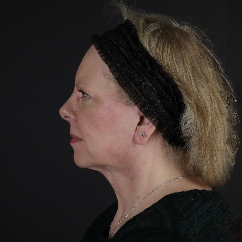 Facelift Before & After Image