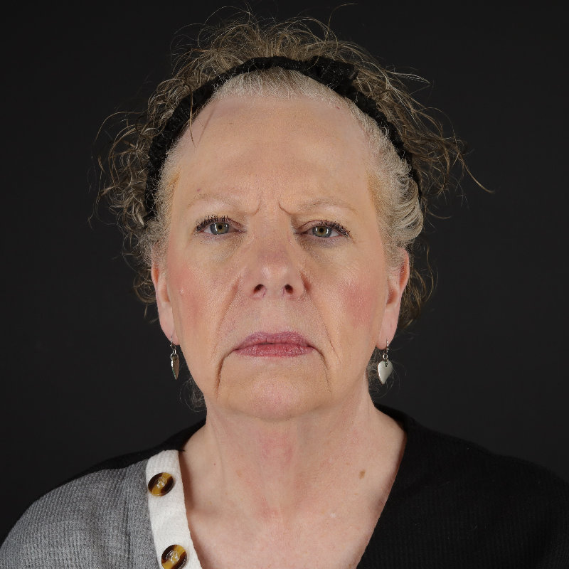 Facelift Before & After Image