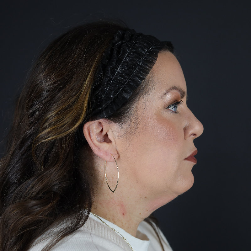 Facelift Before & After Image