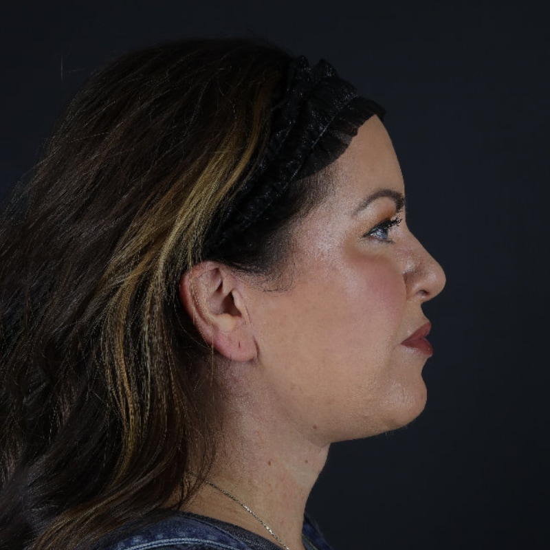 Facelift Before & After Image