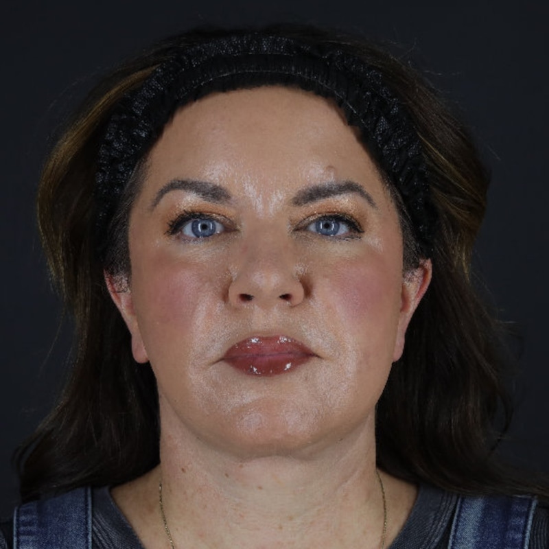 Facelift Before & After Image