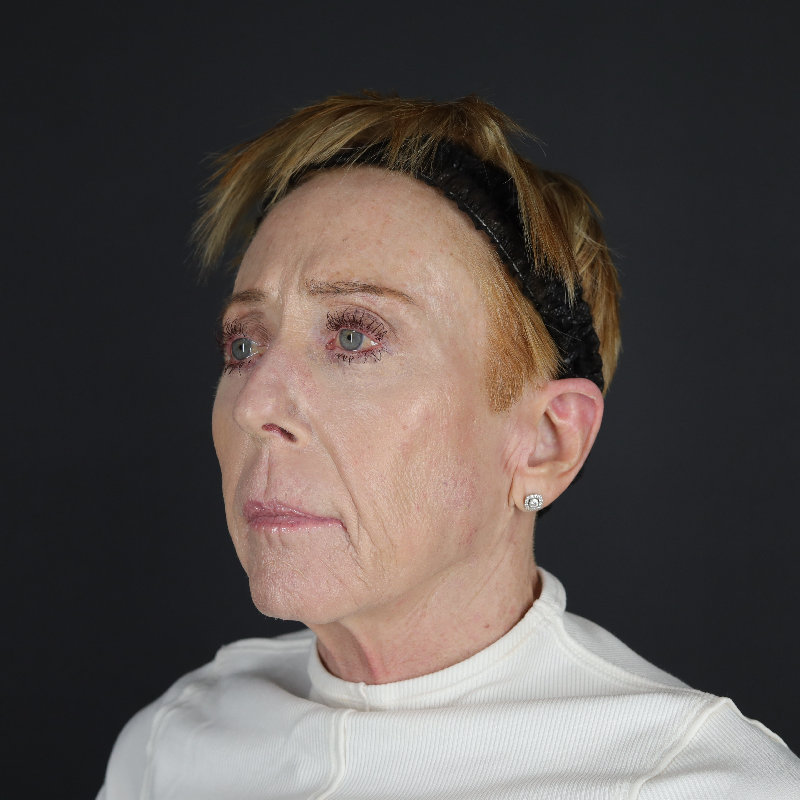 Facelift Before & After Image