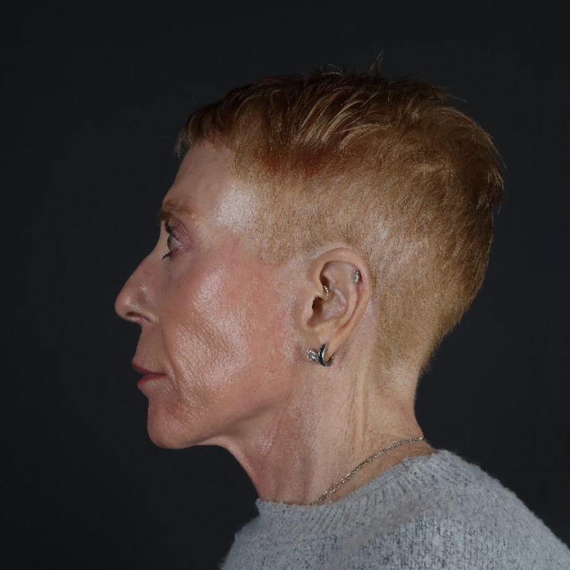 Facelift Before & After Image