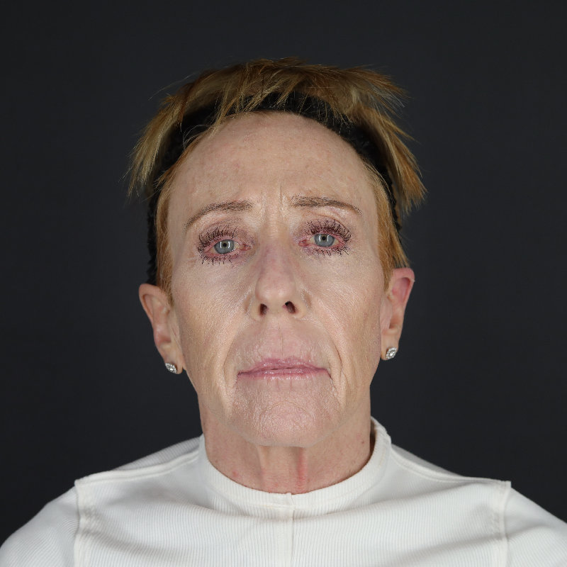 Facelift Before & After Image