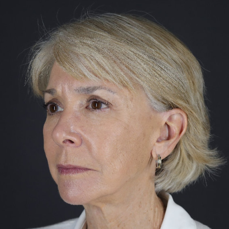 Facelift Before & After Image