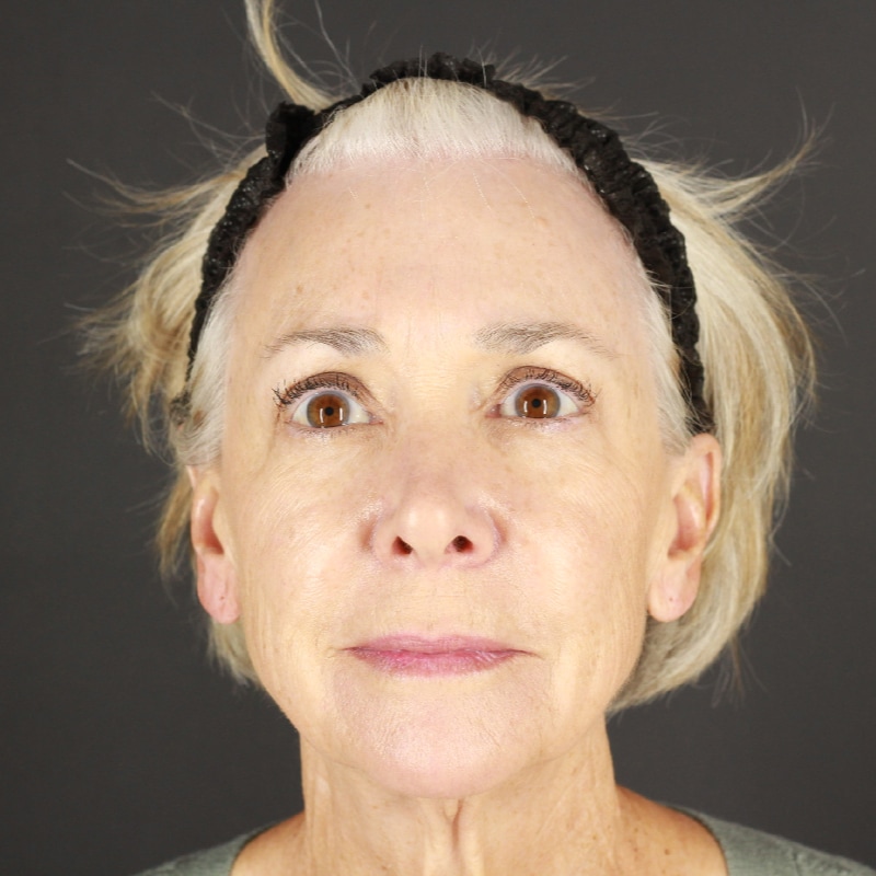 Facelift Before & After Image