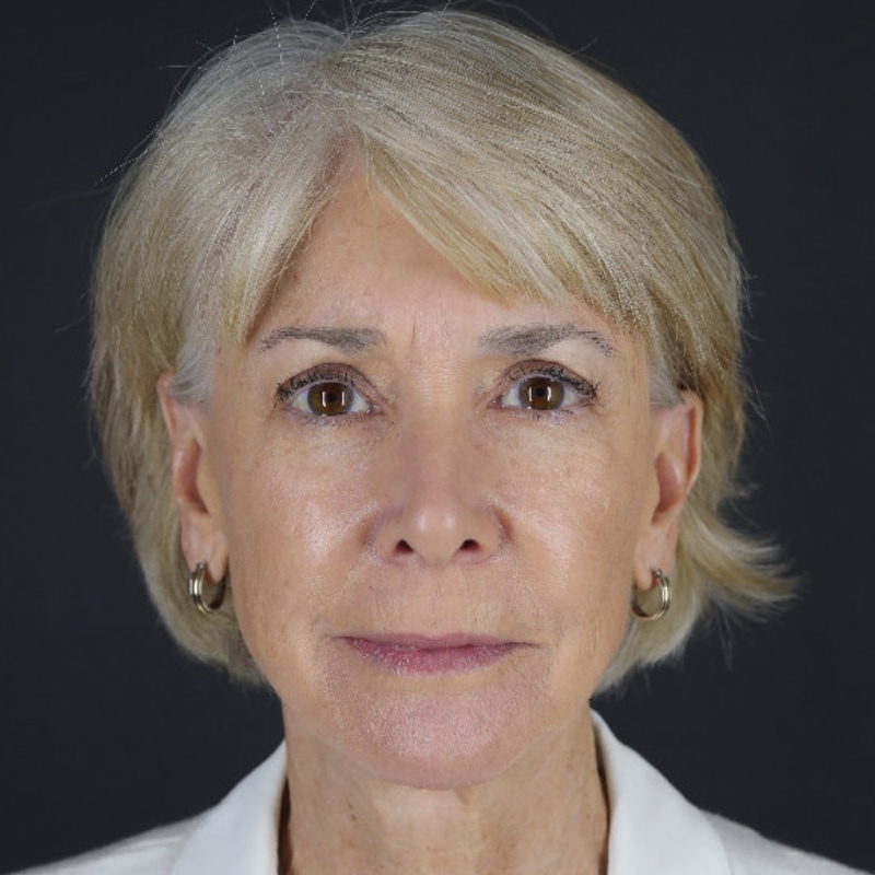 Facelift Before & After Image