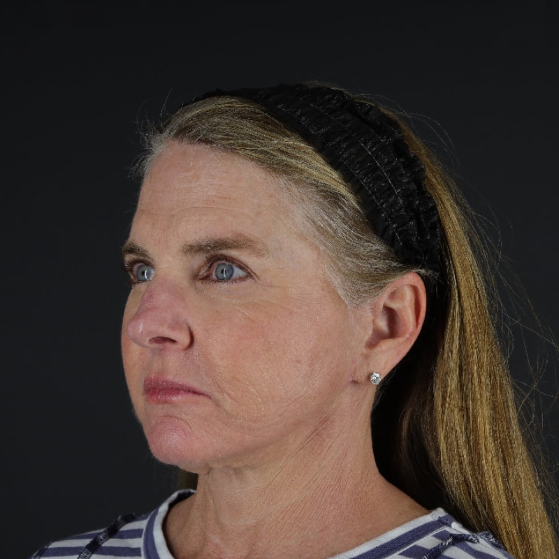 Facelift Before & After Image