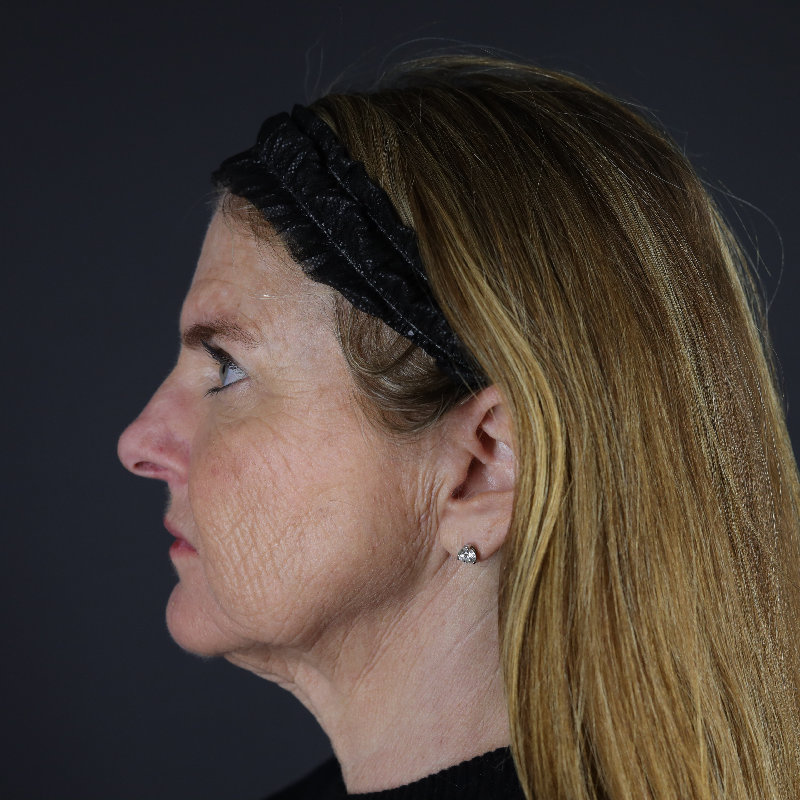 Facelift Before & After Image