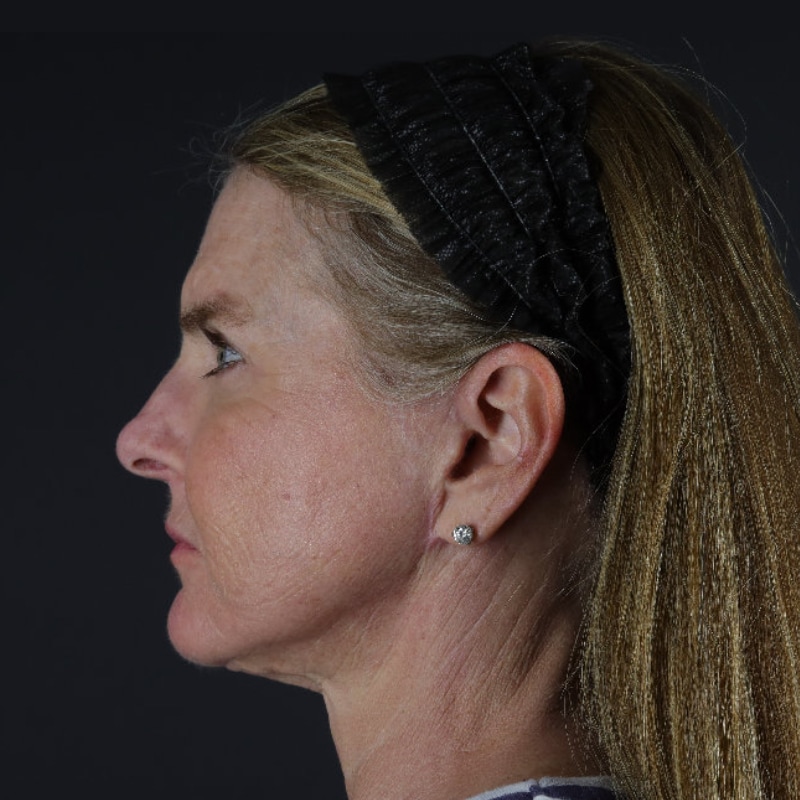 Facelift Before & After Image