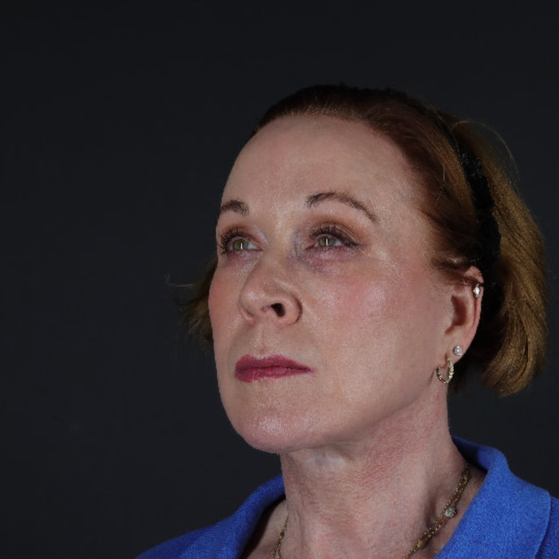 Facelift Before & After Image