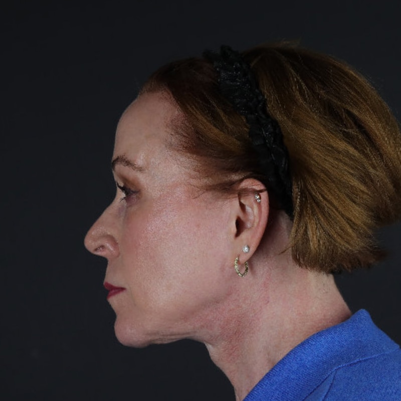 Facelift Before & After Image