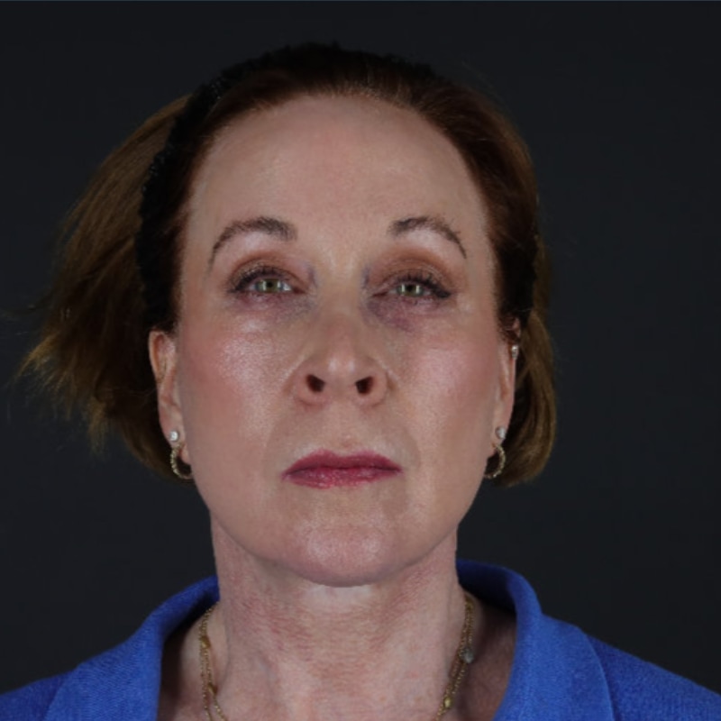 Facelift Before & After Image