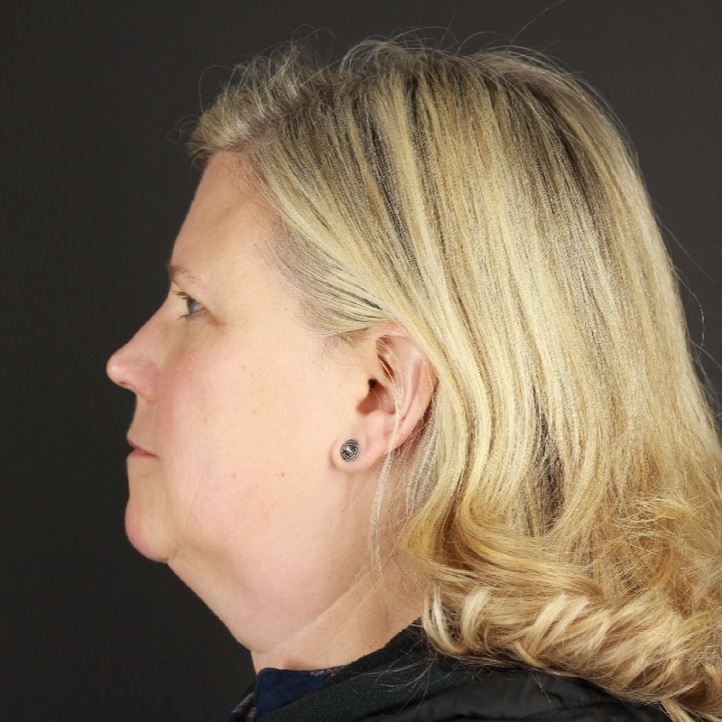 Facelift Before & After Image