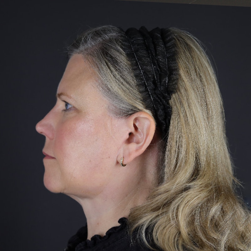 Facelift Before & After Image