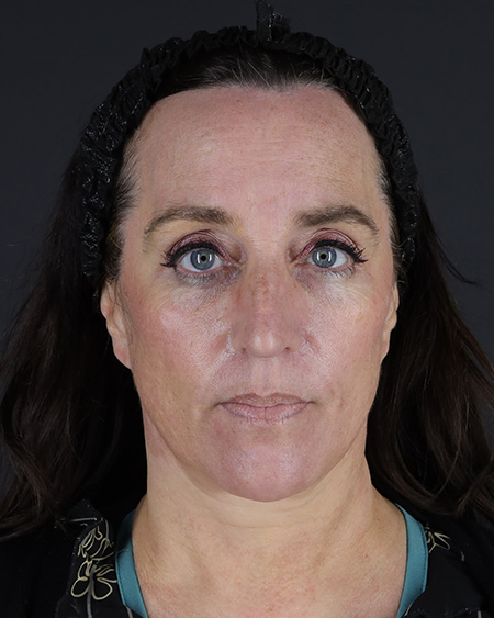 Facelift Before & After Image