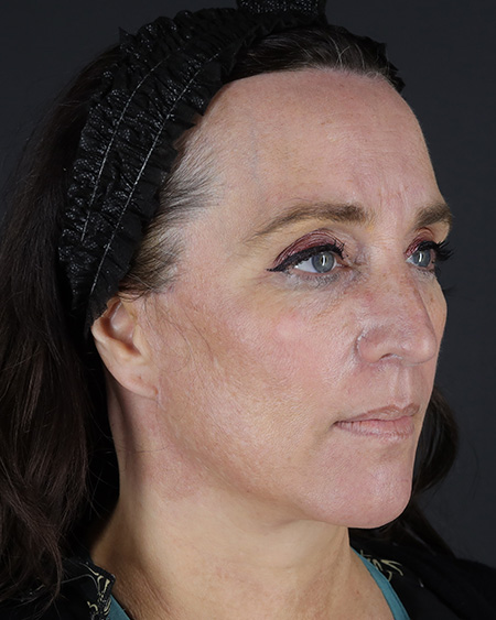Facelift Before & After Image