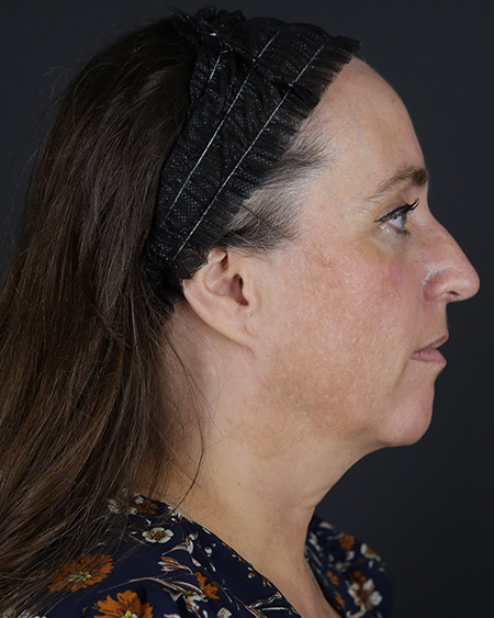 Facelift Before & After Image