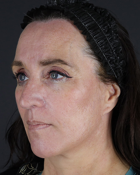 Facelift Before & After Image