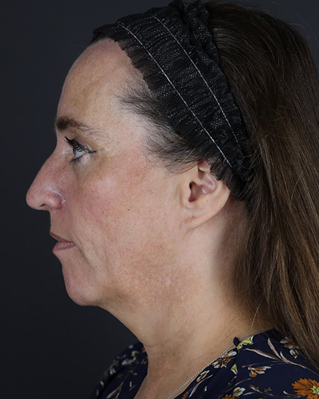 Facelift Before & After Image