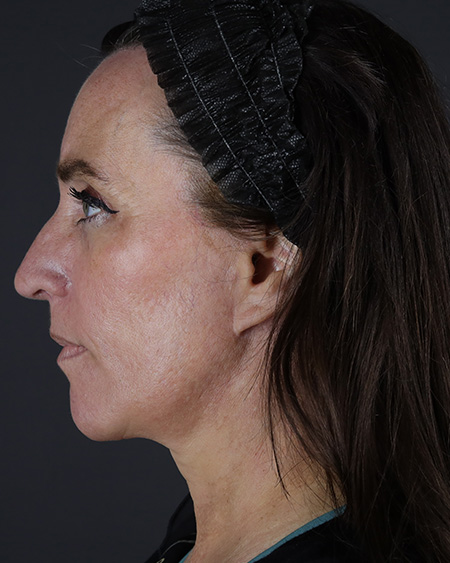 Facelift Before & After Image