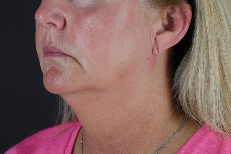 Facelift Before & After Image