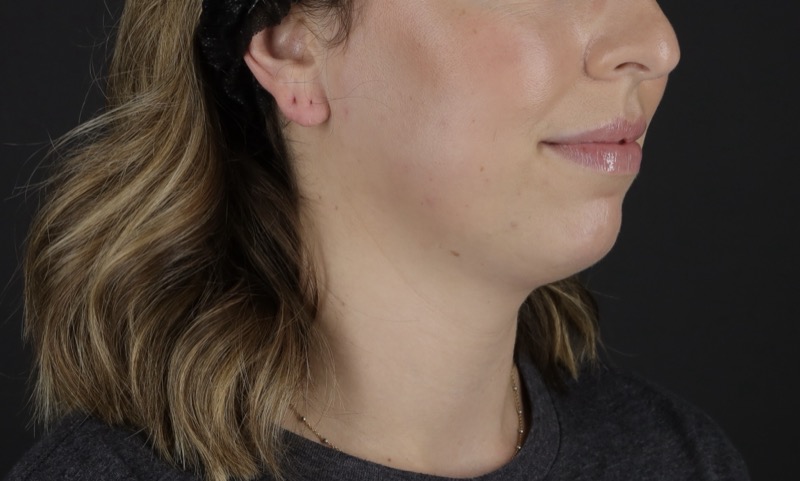 Facelift Before & After Image