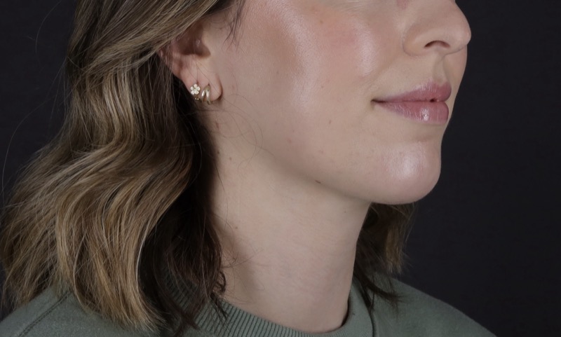 Facelift Before & After Image