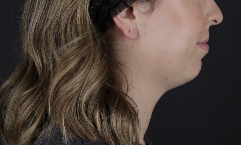 Facelift Before & After Image