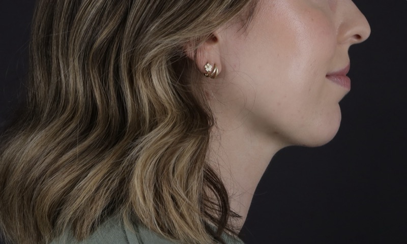 Facelift Before & After Image