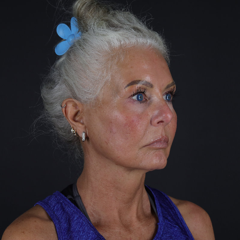 Facelift Before & After Image