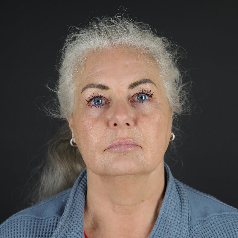 Facelift Before & After Image