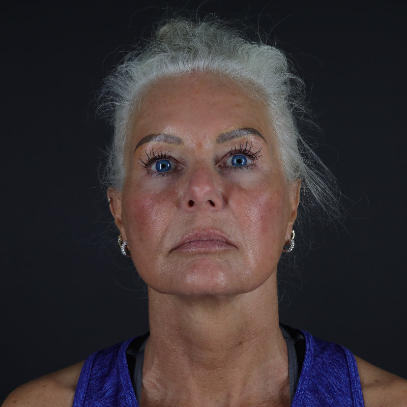 Facelift Before & After Image