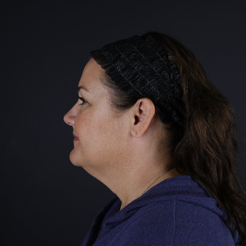 Facelift Before & After Image