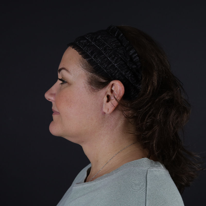 Facelift Before & After Image