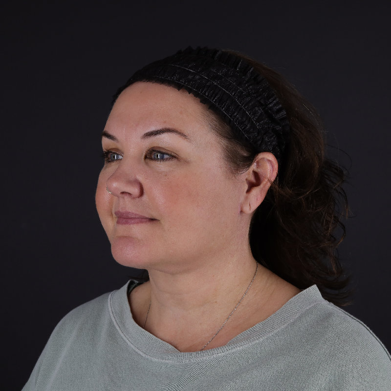 Facelift Before & After Image