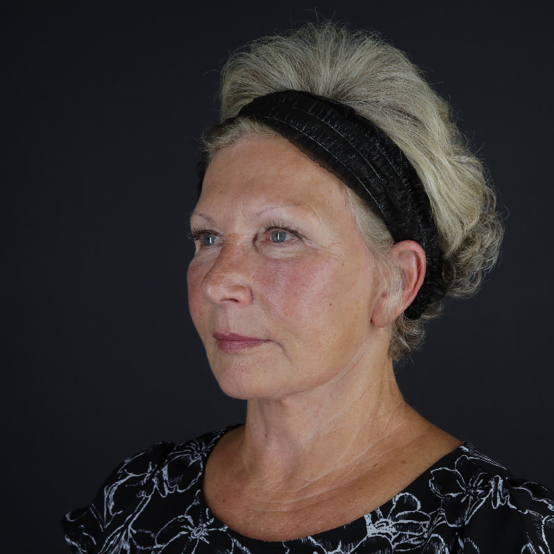 Facelift Before & After Image