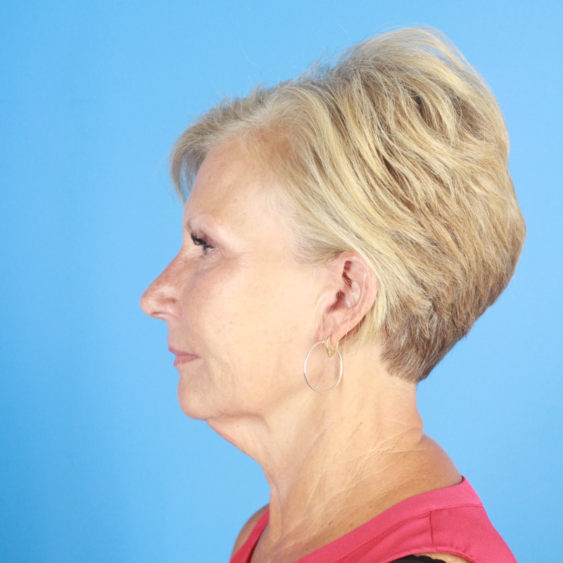 Facelift Before & After Image
